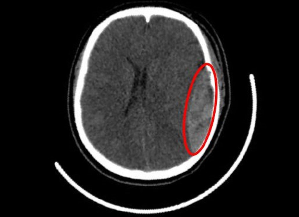Hình ảnh kiểm tra ghi nhận vị trí nứt hộp sọ, máu tụ dưới màng cứng nữ sinh gặp phải